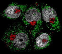 Artesunat aktiviert Krebszell-spezifischen lysosomalen Zelltod