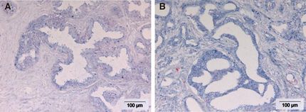 MikroRNAs könnten Hinweise auf die Aggressivität des Tumors geben