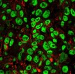 Stress im Sarkom: Neue Ansätze für die Krebstherapie entdeckt