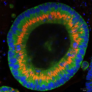 Signalprotein Hedgehog hält Krebsstammzellen am Leben