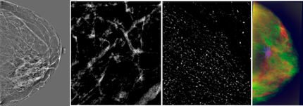 Desarrollan un nuevo sistema de ayuda al diagnóstico del cáncer de mama basado en inteligencia artificial