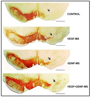 La combinación de dos proteínas tiene un efecto regenerador en el Parkinson