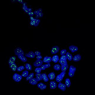 Identifican una proteína que mantiene dormidas las células metastásicas del cáncer de mama