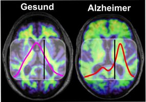 Neuer Bluttest zeigt früh das Alzheimer-Risiko an