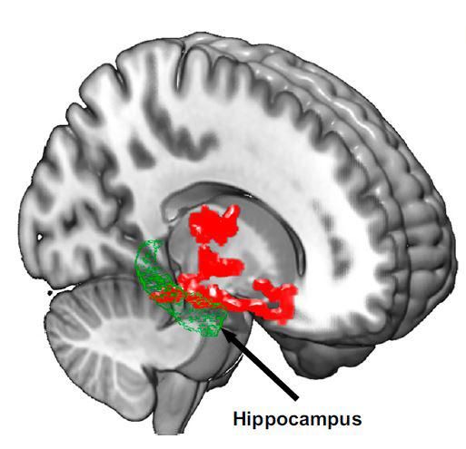 Lack of sleep may be linked to risk factor for Alzheimer's disease