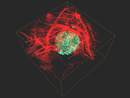 3D-Bilder von Krebszellen im Körper