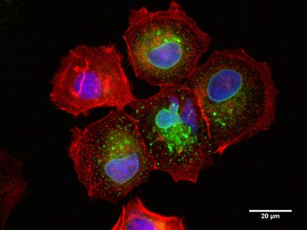 Brustkrebs: Mikroprotein essentiell für Krebswachstum