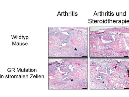 Volkskrankheit Rheumatoide Arthritis