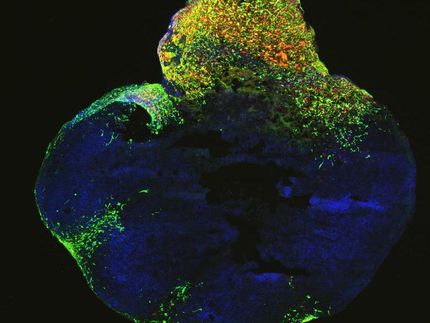 Ein Gehirntumor aus der Petrischale