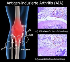 Wie Cortison bei der Behandlung von Rheumatoider Arthritis wirkt
