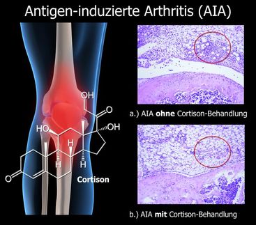 Wie Cortison bei der Behandlung von Rheumatoider Arthritis wirkt
