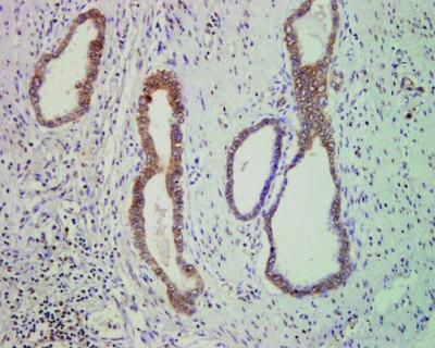 Pancreas tissue with tumors