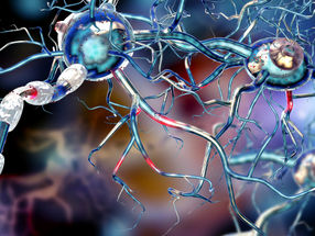 B Cells Among Factors Leading to Brain Lesions in Multiple Sclerosis