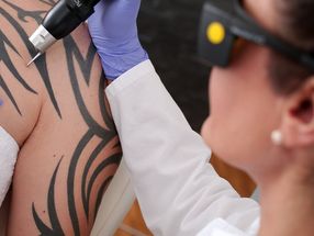 Regeln für Tattoo-Entfernung verschärft