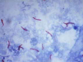 La epidemia de tuberculosis en China se deriva de la expansión de cuatro cepas de bacterias hace mil años