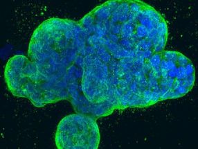 An errant editing enzyme promotes tumor suppressor loss and leukemia propagation