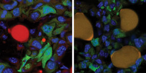 Conversion of breast cancer cells into fat cells impedes the formation of metastases