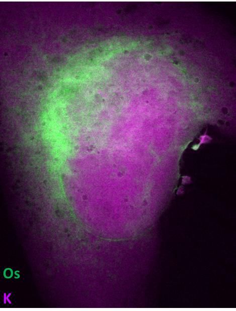 Revealing the path of a metallodrug in a breast cancer cell