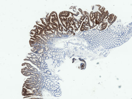 Darmkrebs: Unterschiedliche Wnt-Signalwege bringen Darmzellen auf die falsche Bahn