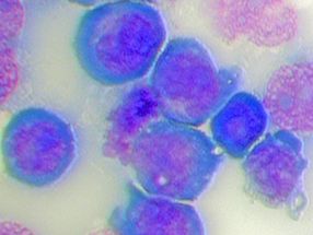 Overlooked molecular machine in cell nucleus may hold key to treating aggressive leukemia