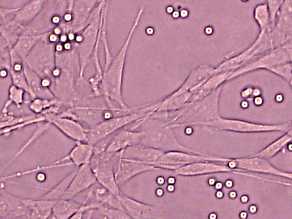 Chronisch Lymphatische Leukämie: Neuer therapeutischer Ansatz