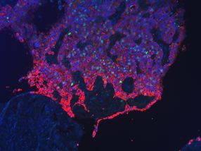 "Landkarte" für Krebswachstum entwickelt