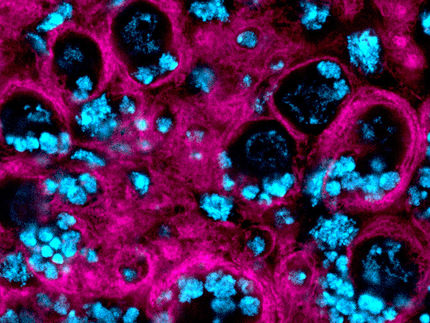 Descrito un nuevo mecanismo celular implicado en la progresión del tumor cerebral más agresivo