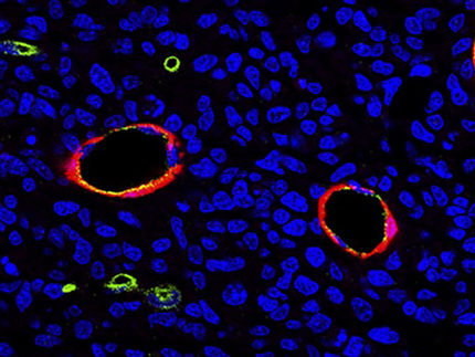 Descubierta una conexión entre un tipo de tumor cerebral y las enfermedades neurodegenerativas