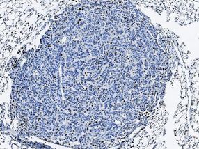 La inhibición de la proteína p38 reduce el crecimiento de tumores de pulmón