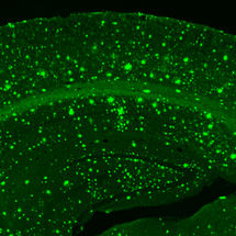 Fortschreiten der Alzheimer-Erkrankung an einzelnen Neuronen zu sehen