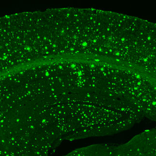 Single-neuron observations mark steps in Alzheimer's disease