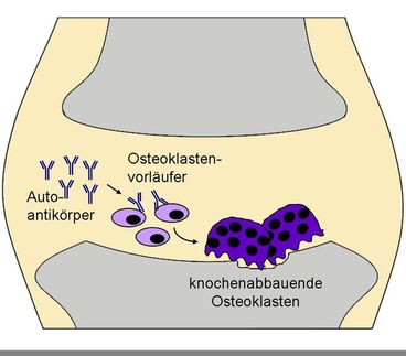 Wie eine Autoimmunreaktion Osteoporose auslöst