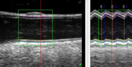 Herzinfarktrisiko durch Ultraschall besser erkennen