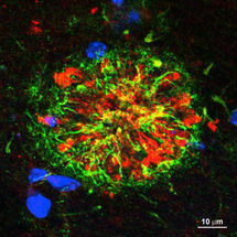 Chronische Hirnentzündungen begünstigen Alzheimer