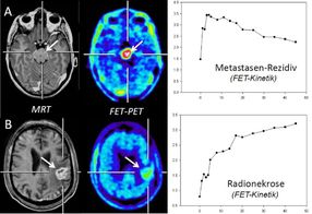 Innovatives Diagnoseverfahren liefert wertvolle Zusatzinformationen bei Hirnmetastasen