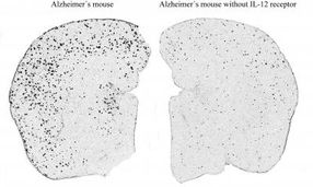 Alzheimer-typische Krankheitsveränderungen