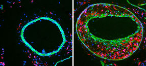 Neuer Mechanismus bei der Entstehung der Arteriosklerose entdeckt