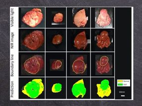 The machine learning technique developed by Dr. Takemura and team could distinguish tumor tissue from healthy tissue in ex vivo images of resected tumors, with 86% accuracy.