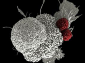 Researchers identify how to prevent cancer metastases
