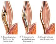 Neue Speiseröhren-Therapie aus Japan nach Würzburg importiert