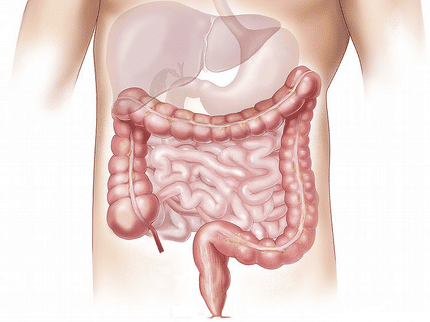 El alto riesgo de cáncer colorrectal en los hombres sólo se explica en parte