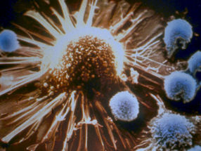 Das richtige Programm könnte Immunzellen zu Krebskillern machen