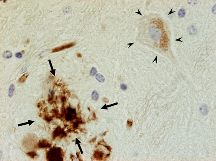 Früher Hinweis auf die Alzheimer-Erkrankung