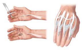 New method restores grip function more quickly to patients with tetraplegia