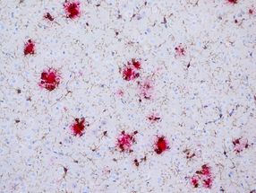 New findings on the brain’s immune cells during Alzheimer’s disease progression
