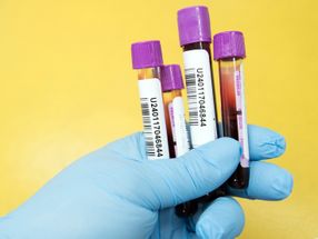 Biomarker im Blut kann Typ-2-Diabetes viele Jahre vor der Diagnose vorhersagen