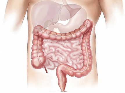 Obesity at a young age - a risk factor for early colorectal cancer