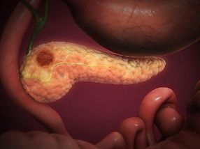 New Biomarker Identified for Early Diagnosis of Pancreatic Cancer