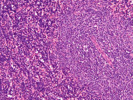 Discovery of a gene that causes chronic lymphocytic leukemia