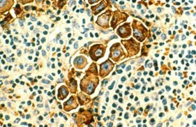 Developmental protein plays role in spread of cancer
